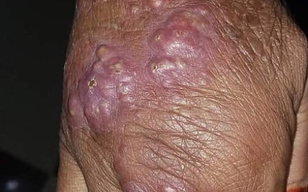 PKDL Treatment Trial a Success 