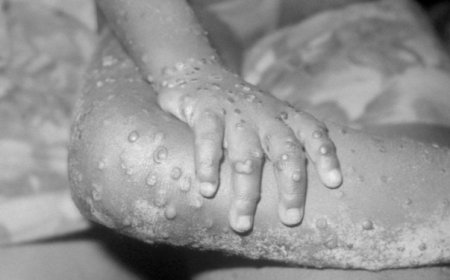 Ministry of Health Confirms Mpox Case as Border Surveillance Intensifies