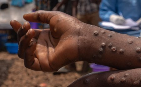 Mpox Virus Outbreak Escalates in Western Kenya as Kakamega Confirms Cases