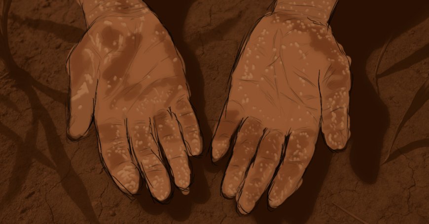 Missing Fingerprints Denied Him a National ID And Decades of Opportunity